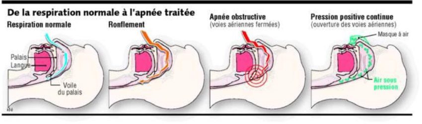 apnee_ppc_1